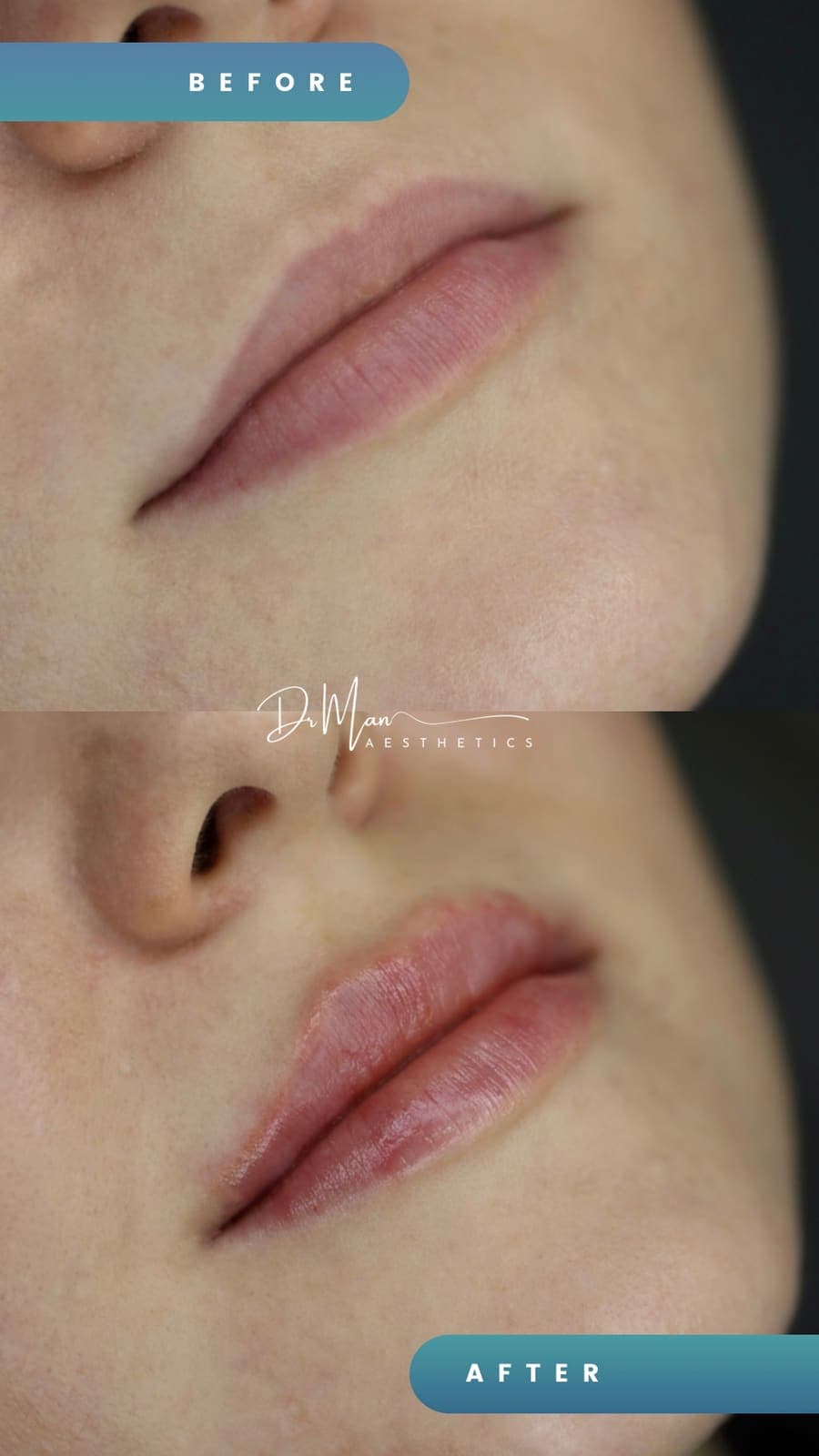 Mărire de buze cu acid hialuronic - înainte și după, vedere din semiprofil