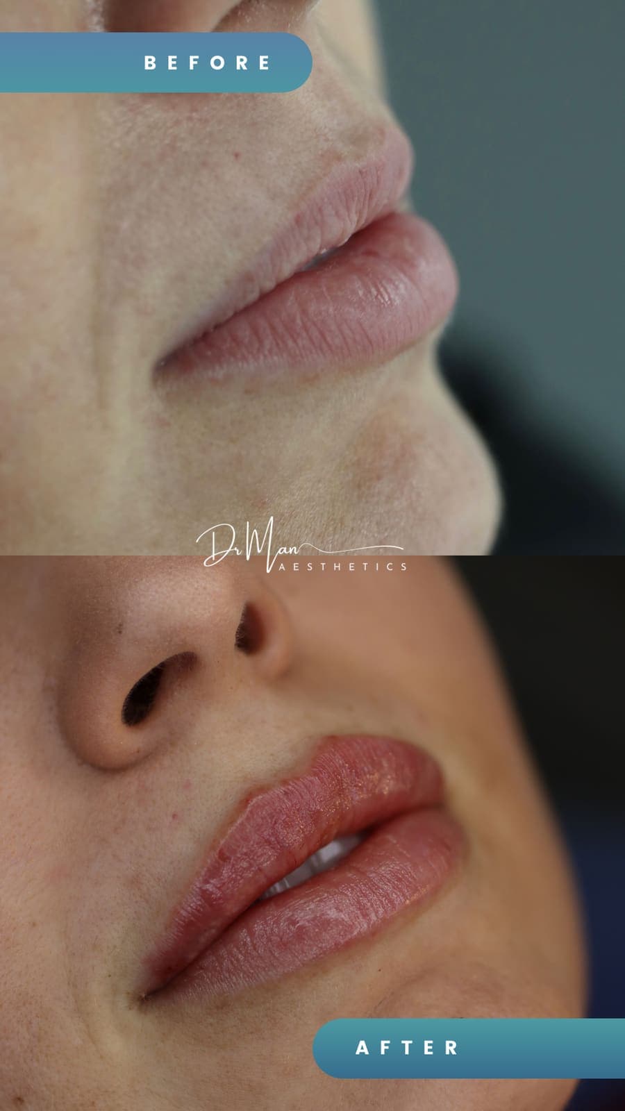 Mărire de buze cu acid hialuronic - înainte și după, cu profilul definit