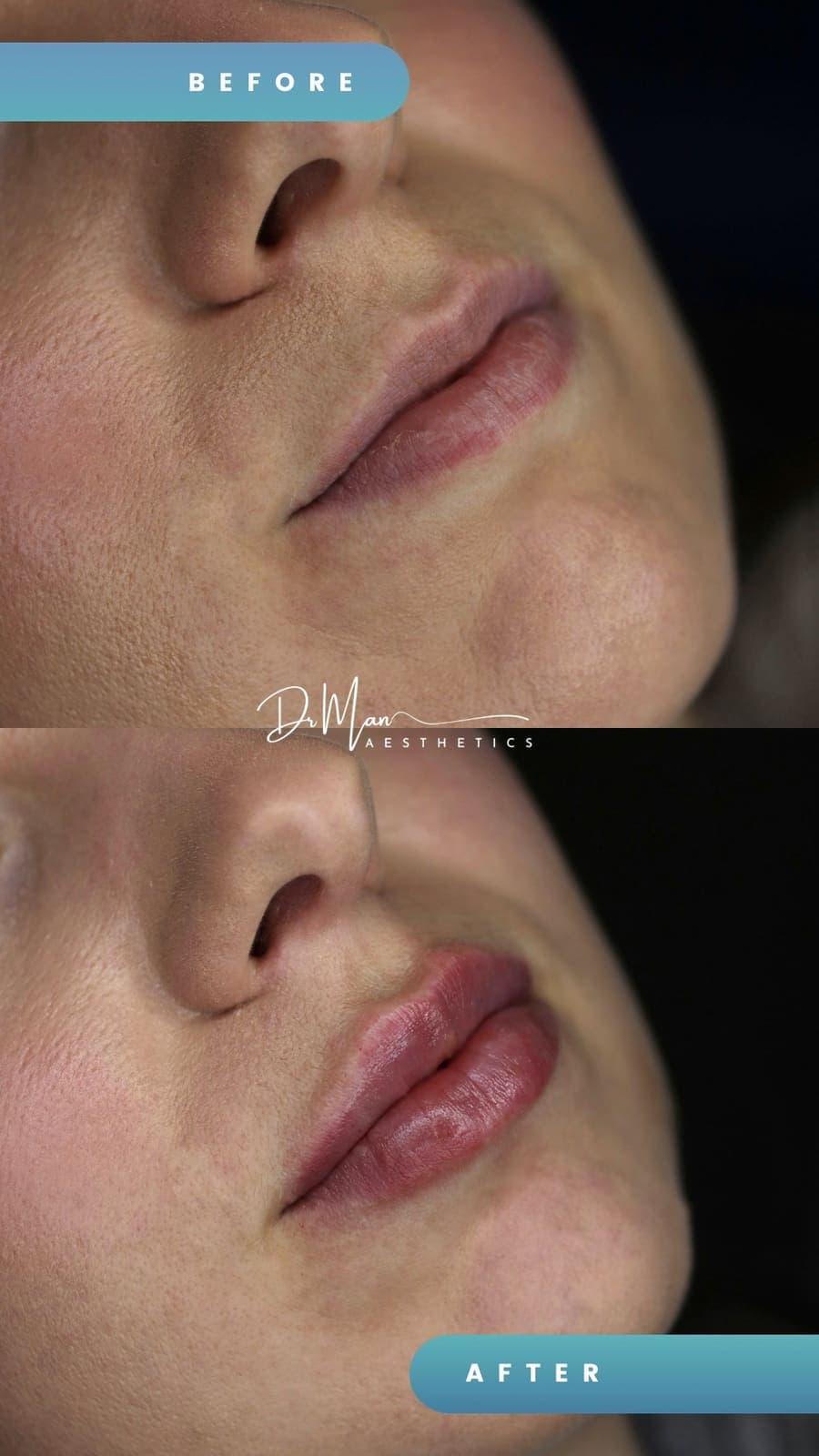 Volumizarea buzelor cu acid hialuronic - înainte și după