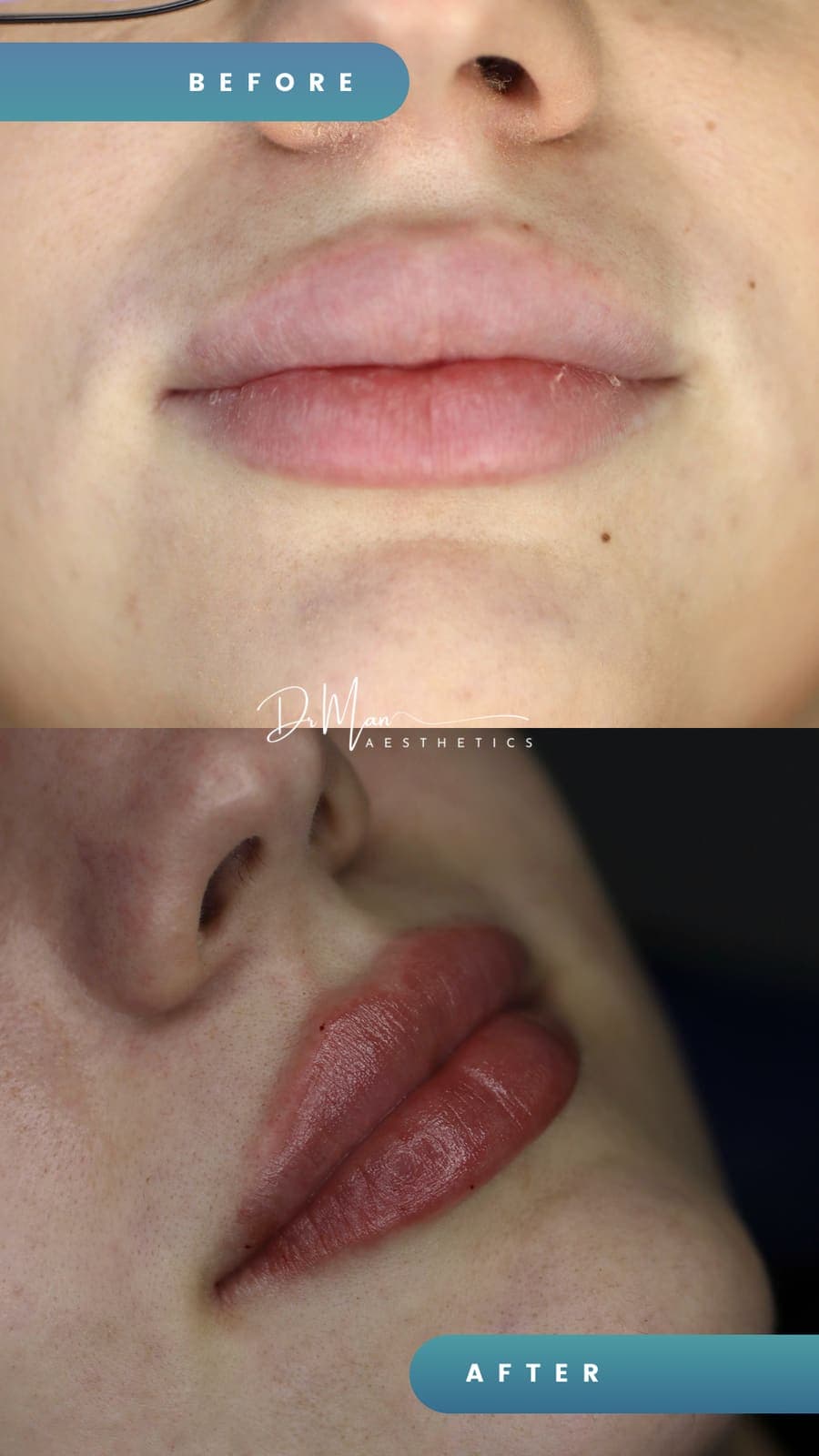 Mărire de buze cu acid hialuronic - înainte și după, vedere de jos