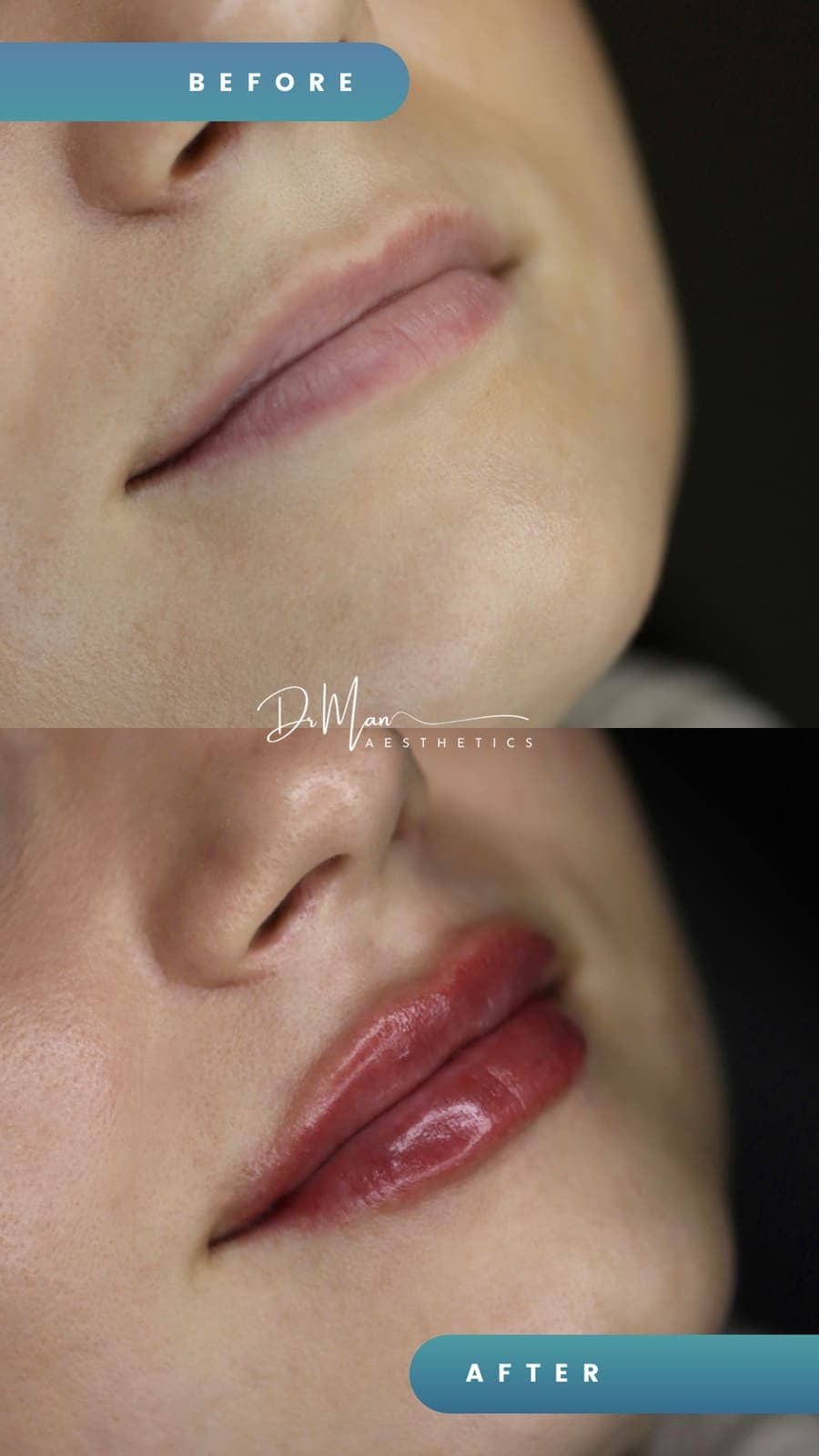 Conturarea buzelor cu acid hialuronic - înainte și după
