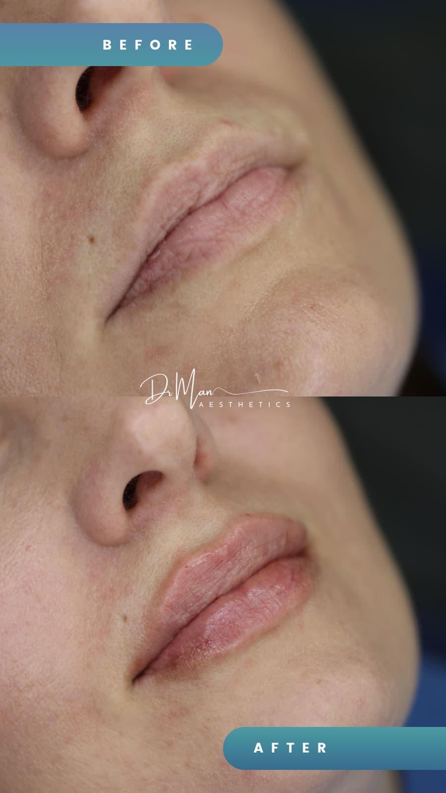 Mărire de buze cu acid hialuronic - înainte și după, semiprofil