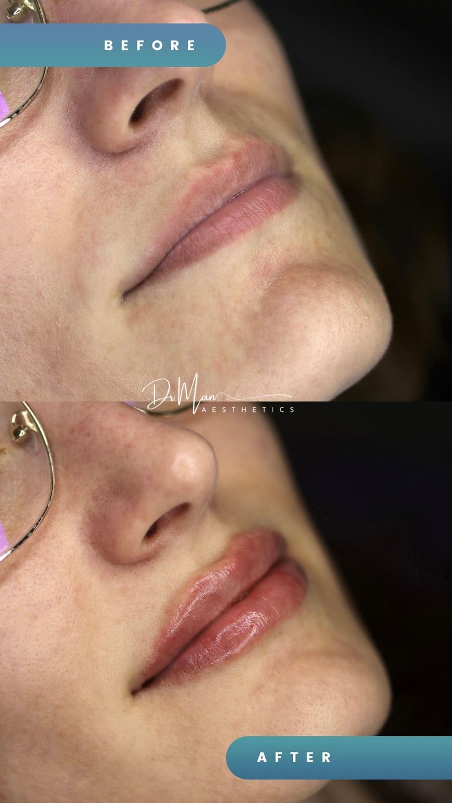 Volumizarea buzelor cu acid hialuronic - înainte și după