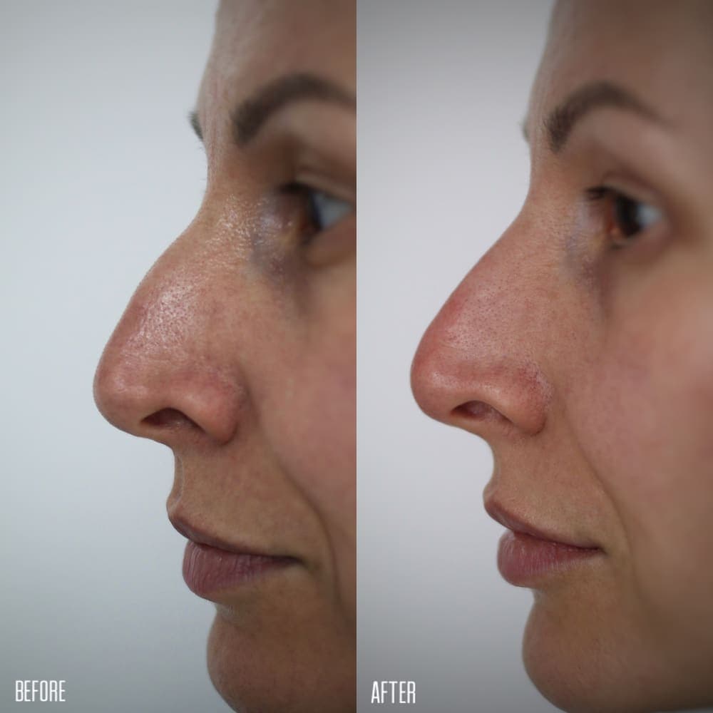 Rinocorecție non-chirurgicală cu acid hialuronic - profil nazal înainte și după