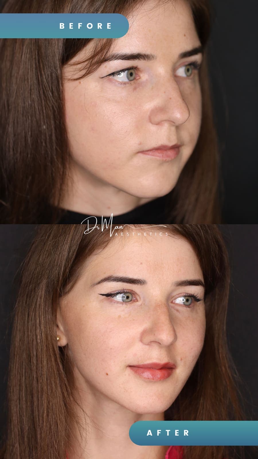 Contur facial înainte și după bichectomie, vedere din semiprofil