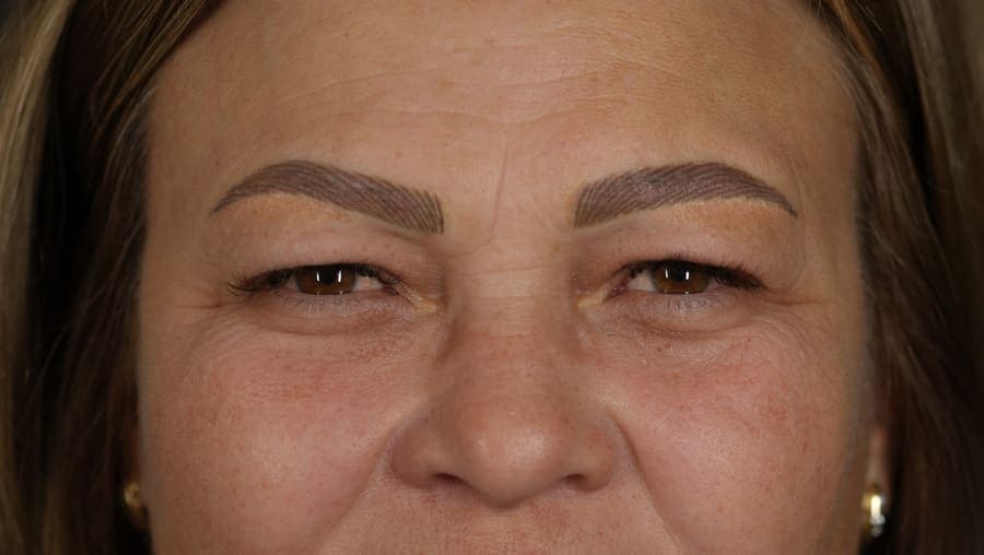 Înainte de blefaroplastie