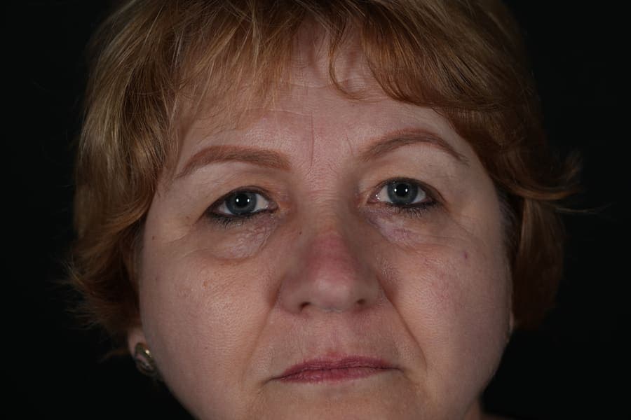 Înainte de blefaroplastie - exces de piele la pleoapele superioare