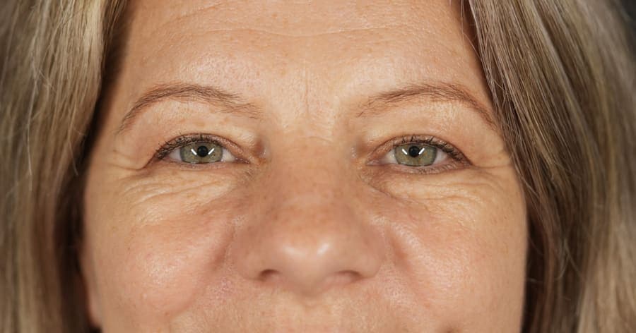 Înainte de blefaroplastie