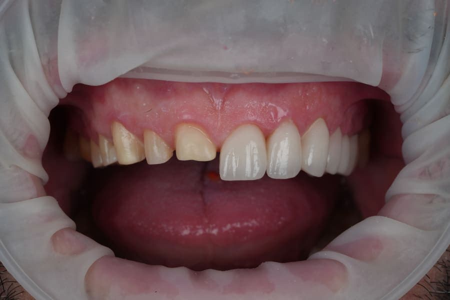 Aspect intraoral cu o parte din arcada superioară restaurată cu coroane albe, alături de dinții încă netratați