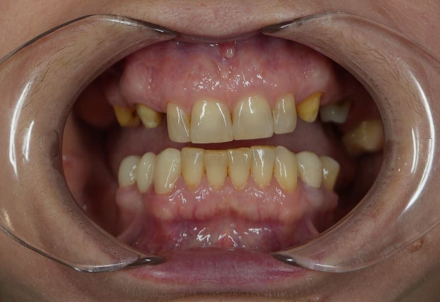 Înainte - aspect intraoral