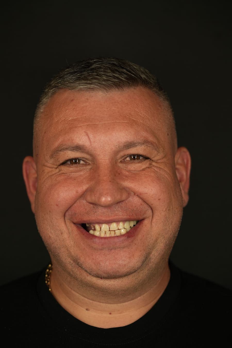 Înainte de fațetele dentare