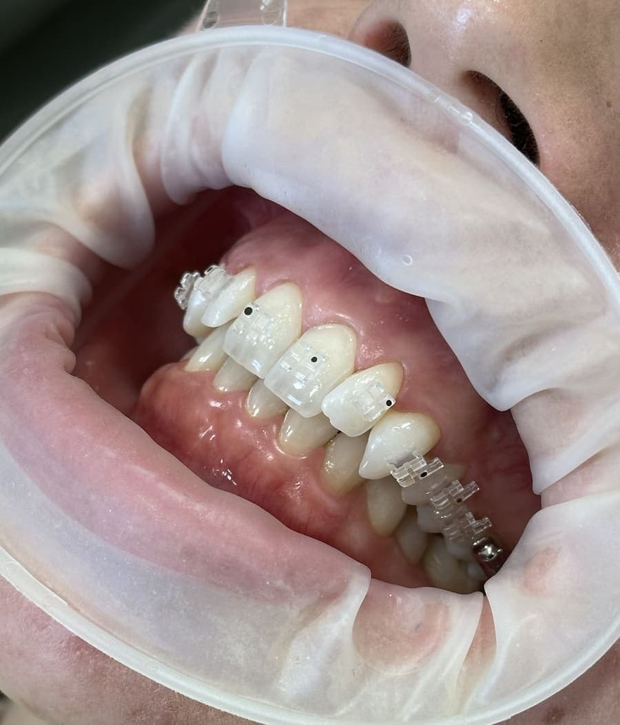 Aparat dentar fix cu bracket-uri din safir, transparente, pe arcada superioară