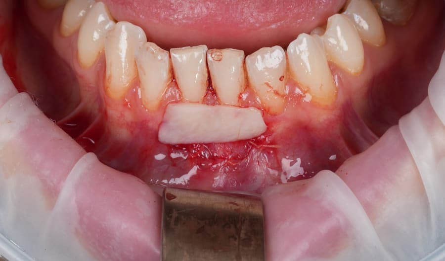 Poziționarea grefei de țesut gingival peste zona cu recesie