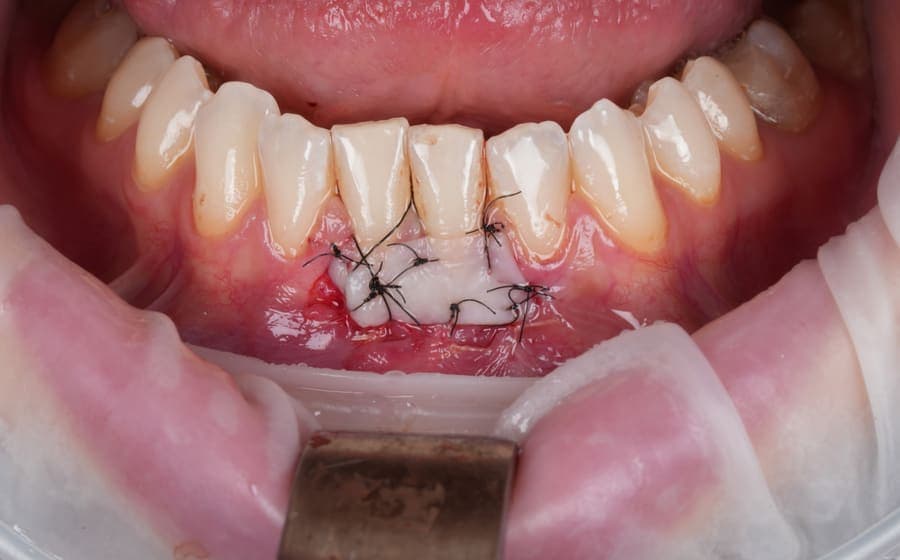 Sutură grefă gingivală în tratamentul parodontal