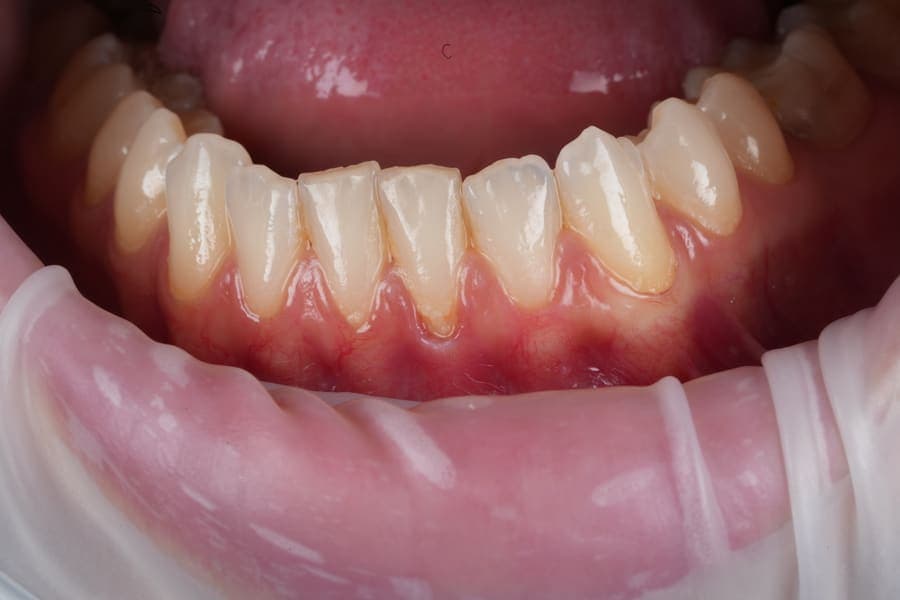 Recesie gingivală - înainte de tratamentul parodontal