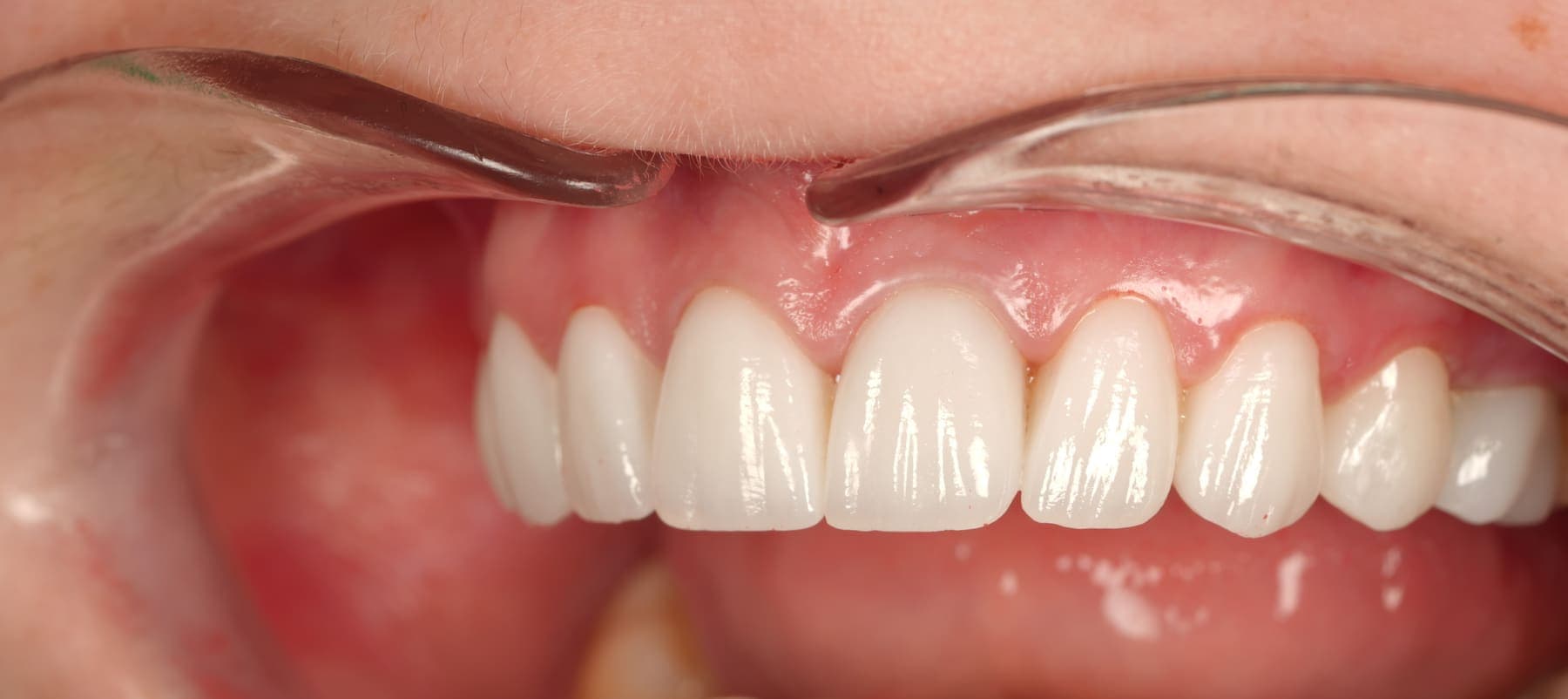 Dinți frontali superiori restaurați cu lucrări ceramice, fotografiați intraoral