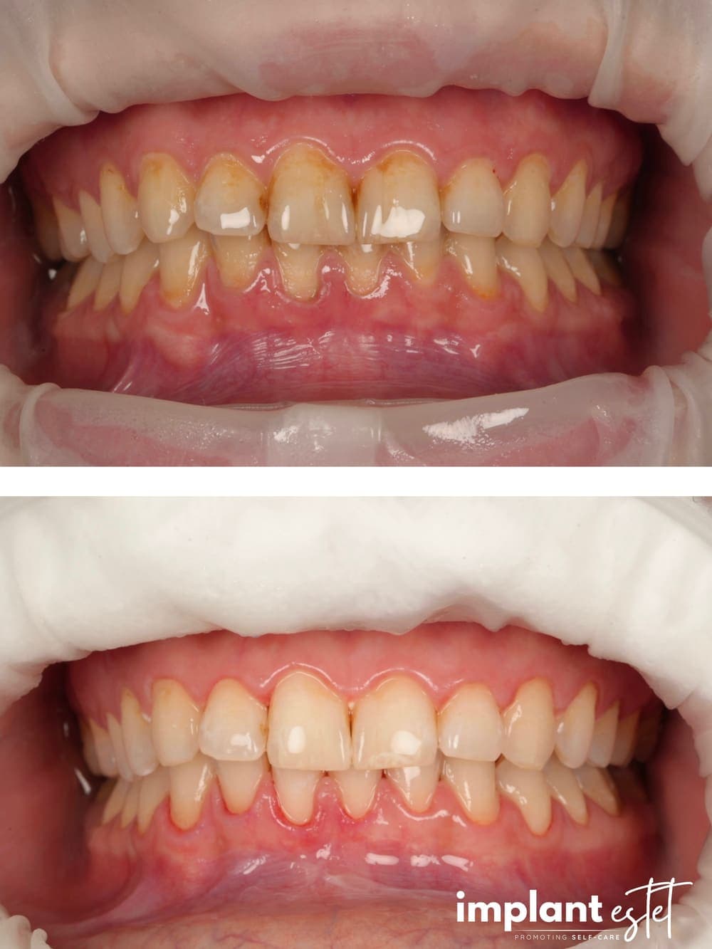 Comparație intraorală după albirea dentară: sus dinții înainte, jos după tratament