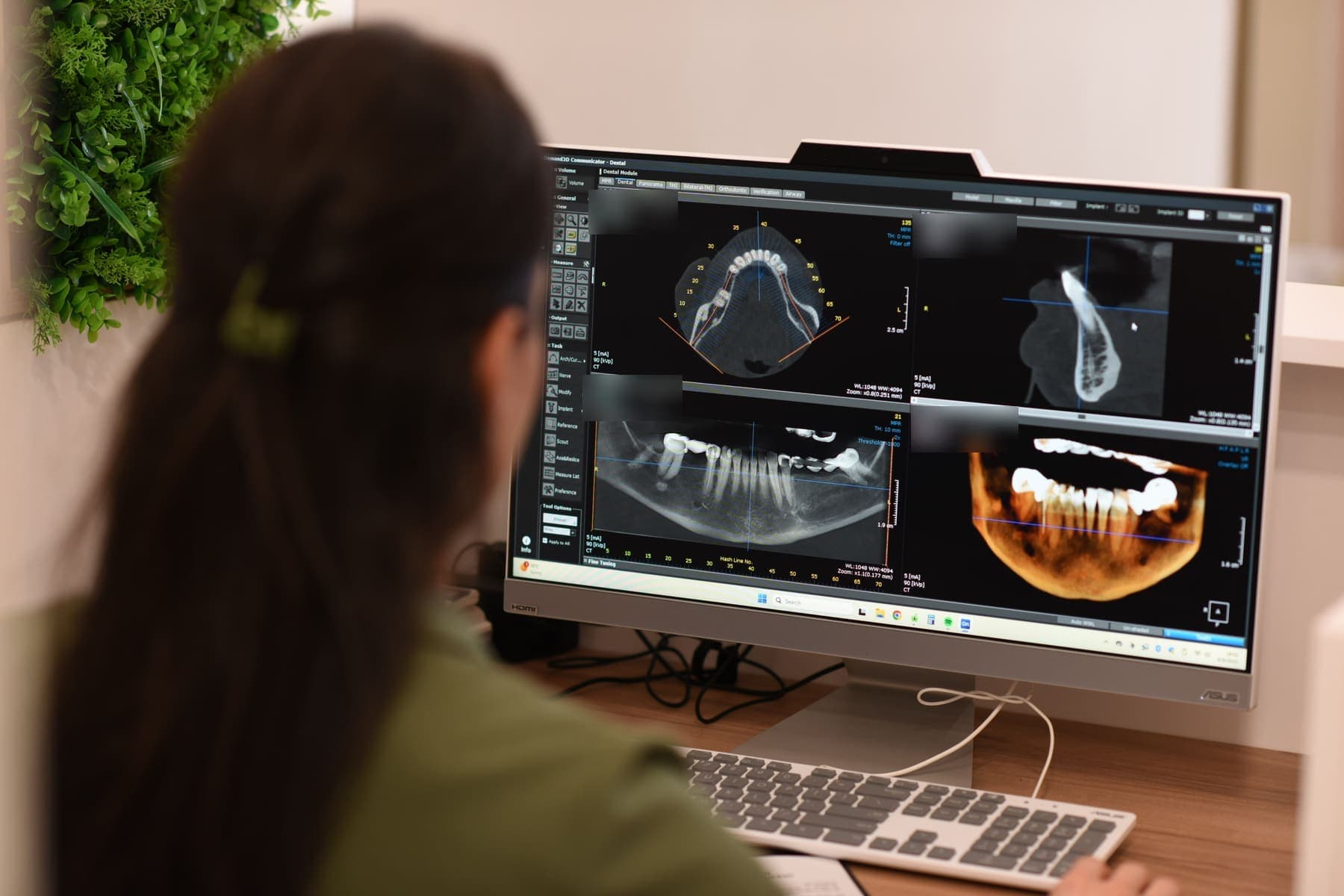 Planificarea implantologică pe tomografia CBCT, afișată pe monitorul din cabinet