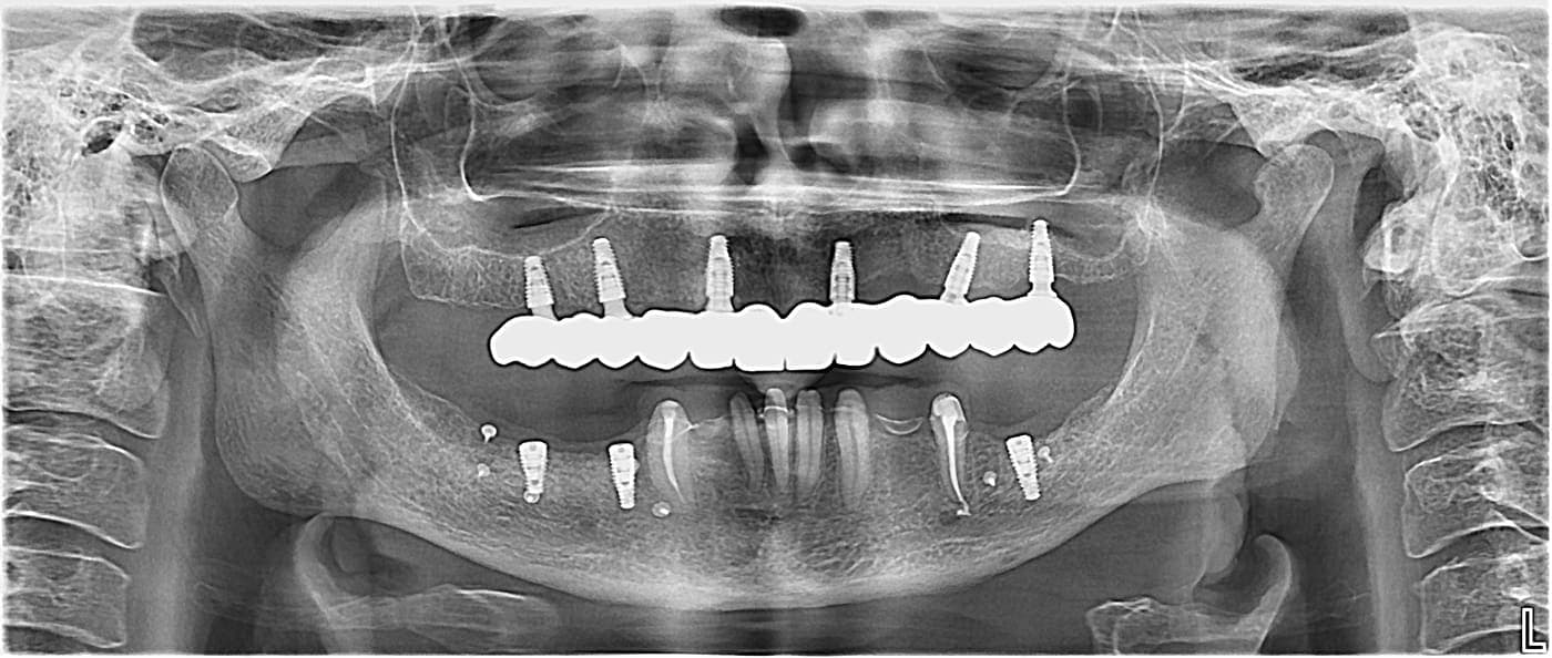Radiografie panoramică după o reabilitare cu dantură fixă pe implanturi: implanturile din titan integrate în os susțin lucrarea fixă