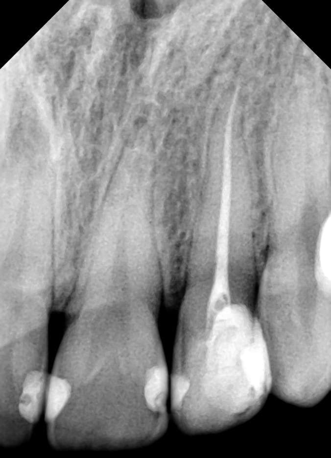 Radiografie retroalveolară cu canalul radicular obturat până la apex după tratamentul endodontic