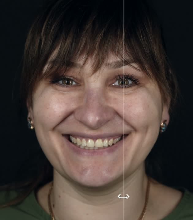 Design virtual al zâmbetului pe ecran, în etapa de planificare a unei lucrări estetice