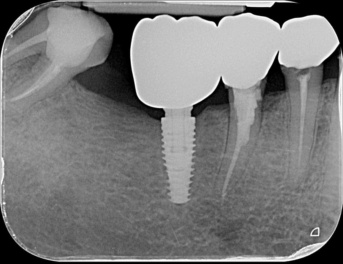 Radiografie retroalveolară cu un implant dentar din titan osteointegrat și coroana montată deasupra